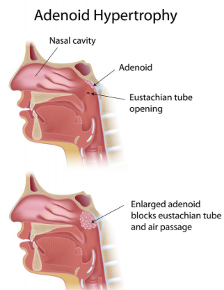 adenoids homeopathic medicine