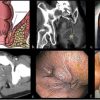 ano rectal diseases homeopathy medicine.jpg