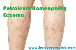 petroleum homeopathy eczema