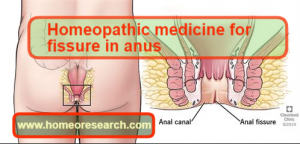 Homeopathic medicine for fissure in anus