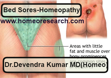 homeopathic-treatment-and-medicines-for-bed-sores