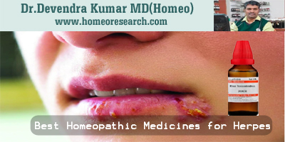 Best Homeopathic Medicines for Herpes